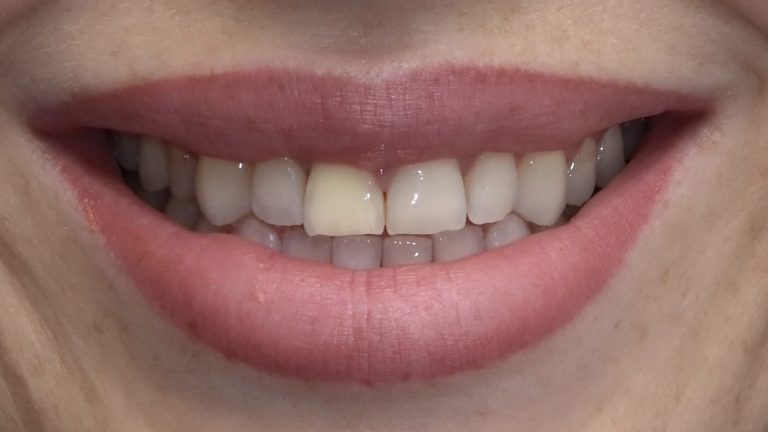 Smaids pirms zobu taisnošanas un venīriem. DrBite