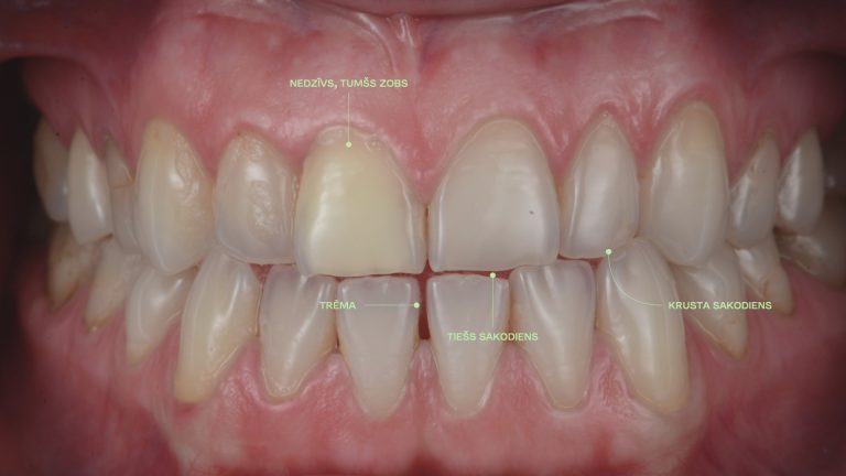 SItuācija pirms zobu taisnošanas un venīriem - DrBite