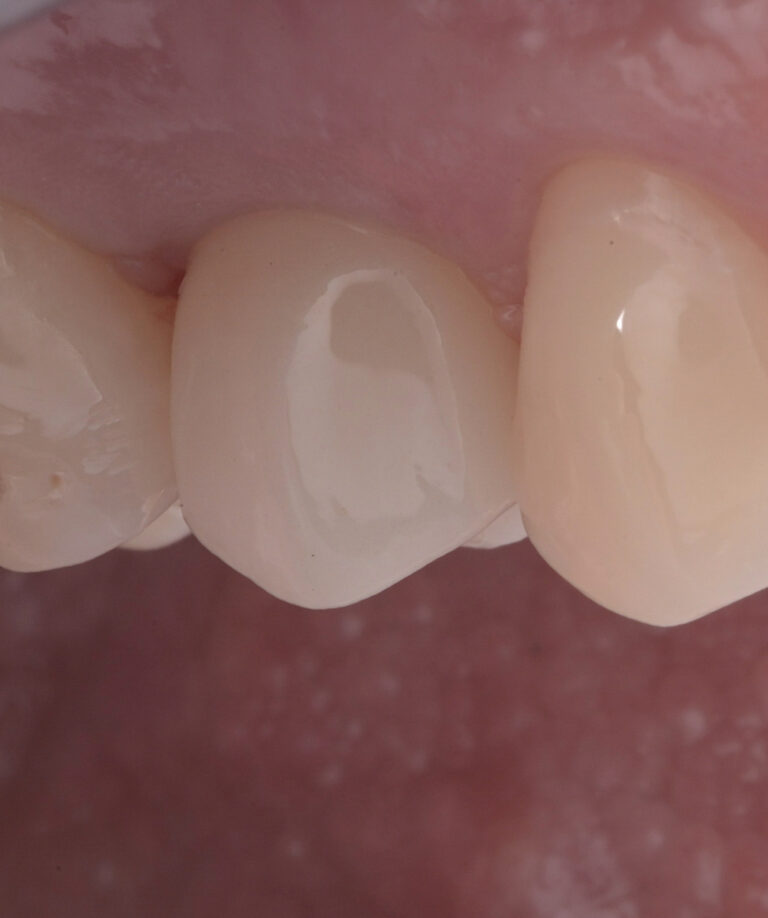 Pastāvigais cirkonija kronis uz implanta