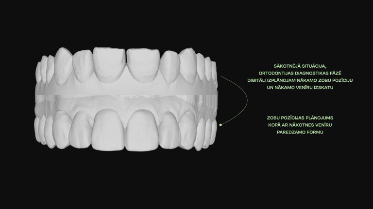 Zobu venīri - lielākā daļa uzvaras ir plānošanā. DrBite