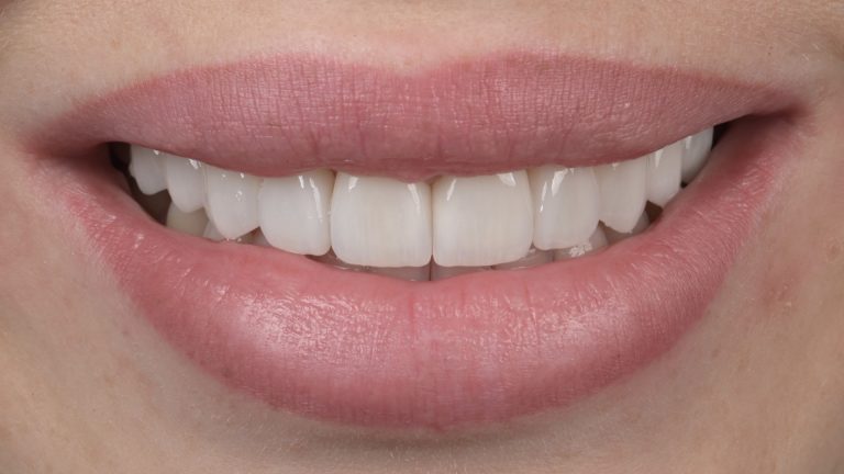 Trauslu zobu atjaunošna ar venīriem – DrBite