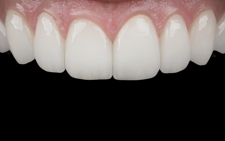 Mazinvazīvi, biomimētiski un gaiši venīri. DrBite