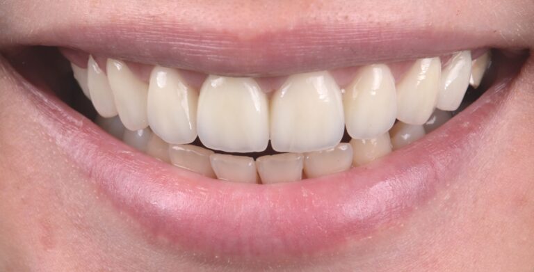 Pacenta smaids pēc procedūras ar skaistiem zobiem. DrBite