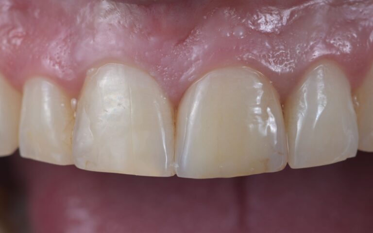 Lūzušajam zobam izveidojām keramikas kroni, kurš maksimāli līdzinās saviem zoba audiem