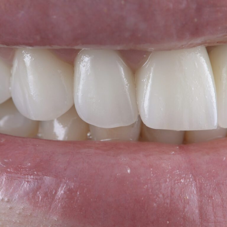 Zobu venīri, venīri - mazinvazīvi slīpētiem zobiem gaiši, dabīga izskata venīri