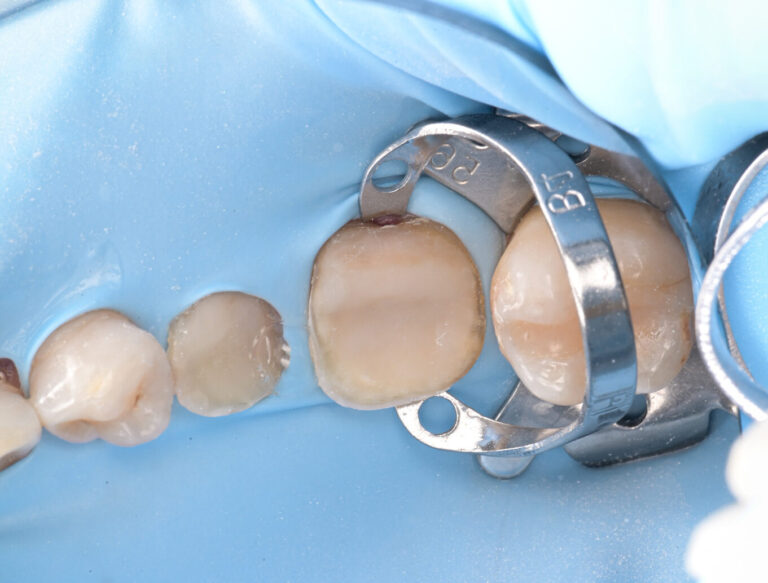 Biomiētiska keramikas restaurācija procedūras laikā.