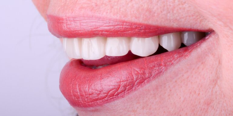 Zoba tilts - vairāki zobi tika sagatavoti zoba aizvietošanai un izgatavots cirkonija keramikas tilts