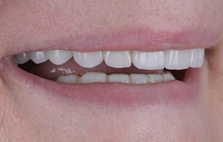 Totālā izņemamā bez akrila zobu protēze augšžoklī