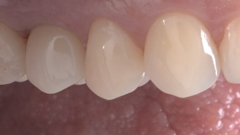 Sadzijis zobu implants pēc procedūras.