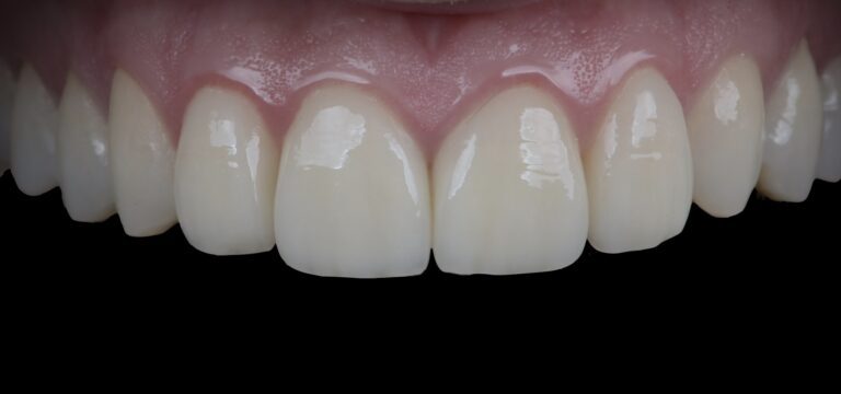 Cirkonija keramikas kroņi četriem priekšzobiem