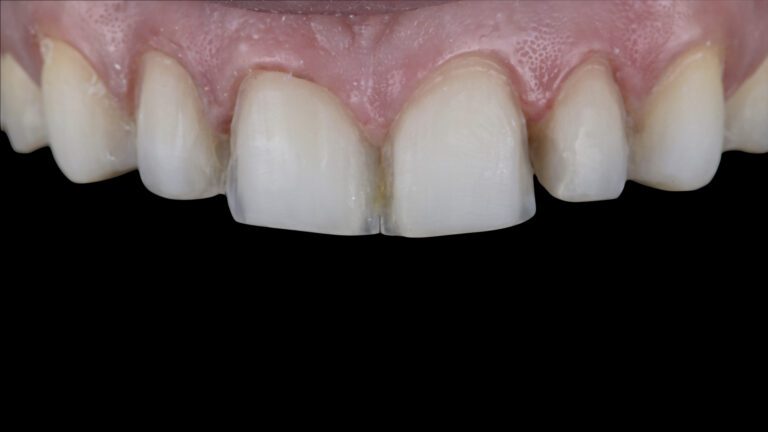 Zobu slīpēšana priekš venīriem. DrBite