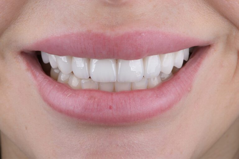 Smaids, kas uzlabots ar zobu venīriem.